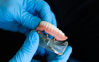Overdenture supported by implants